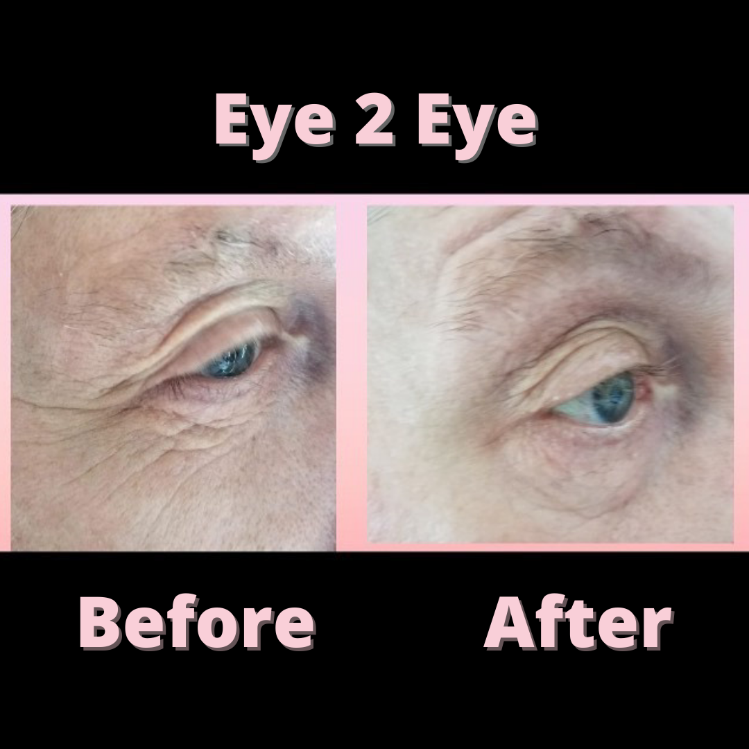 Eye 2 eye day and night eye cream before and after results
